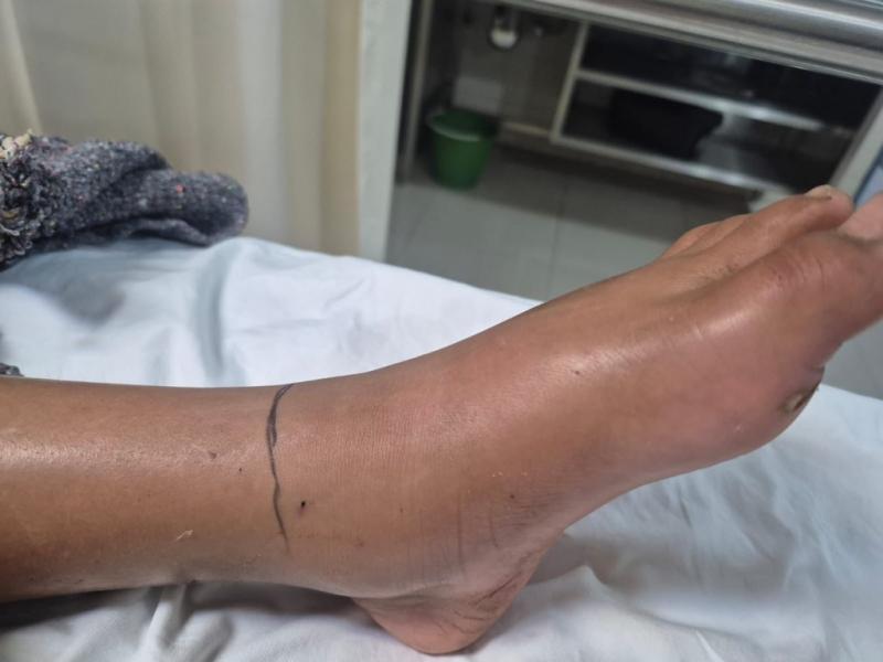 Coordinación entre SSP y SSY salva la vida de adolescente tras mordedura de serpiente en Tizimín